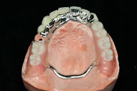 removable partial dentures lab procedure